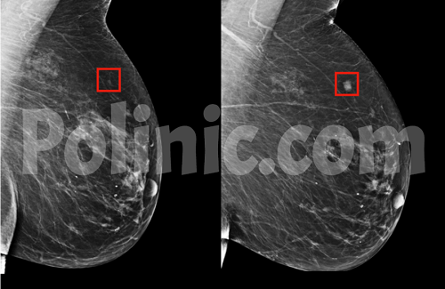 تصویر ماموگرافی سرطان سینه 